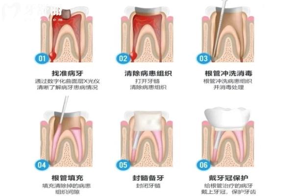 蛀牙隐隐作痛要根管治疗吗