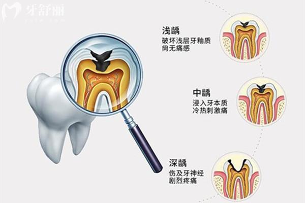 如何判断蛀牙有没有伤到牙髓