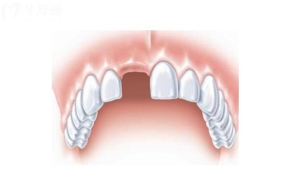 长期缺牙的危害：牙槽骨缺失/引发口腔疾病等附上类型与方法