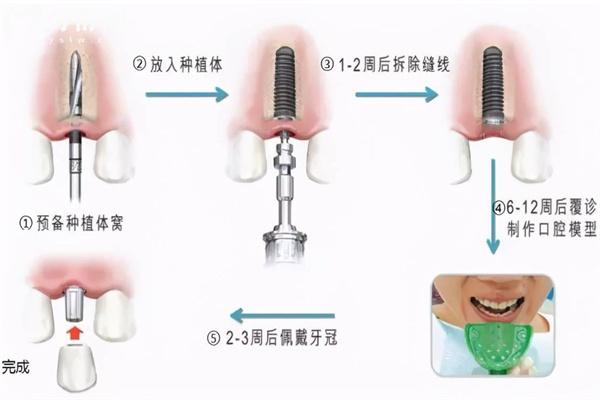 种植牙牙桩掉下来了怎么办?