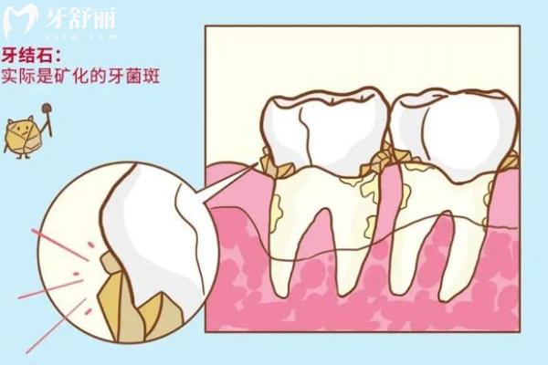 先洗牙还是先拔牙补牙？