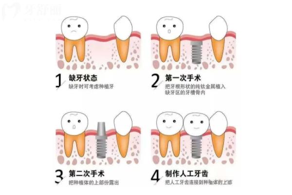 即刻种植牙好还是3月后种植好