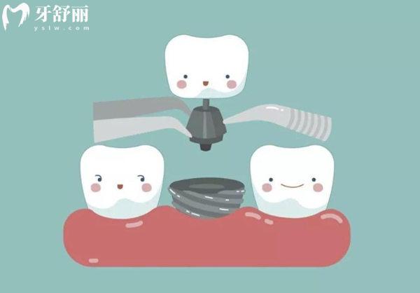 北京牙科医院种植牙价格表
