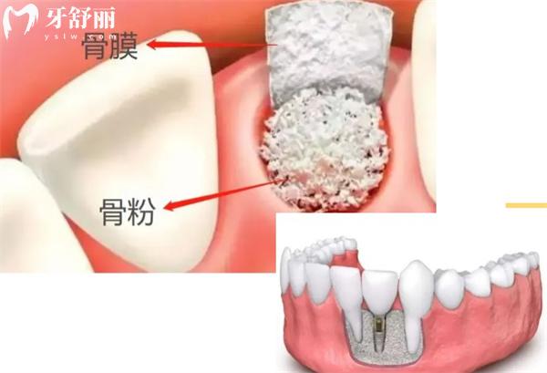 种植牙牙槽骨的标准条件