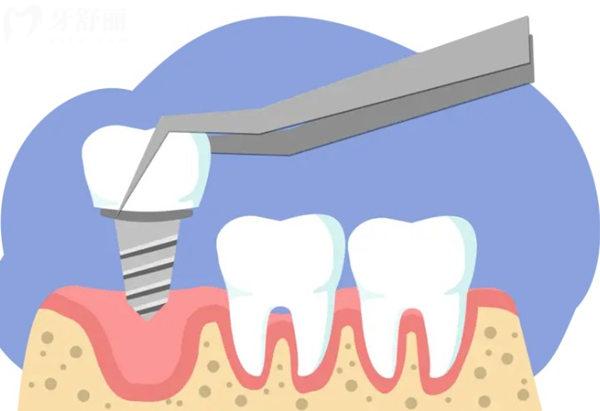 牙槽骨种植牙的注意事项