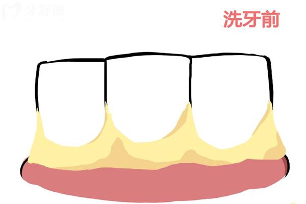 原来洗牙不能美白牙齿!想要牙齿美白这些方法学起来!