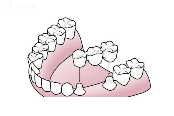 为什么缺一颗牙医生让镶三颗？保持牙齿稳定/维持牙槽骨健康等原因