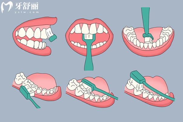 正确刷牙方法-巴氏刷牙法