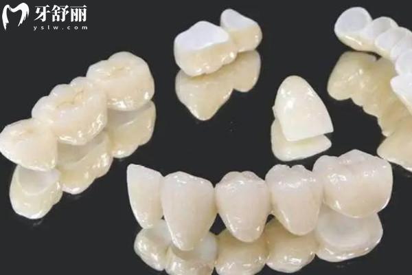 门牙全瓷牙冠选什么牌子好