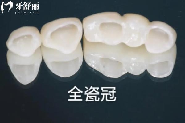 进口牙冠就比国产的好吗