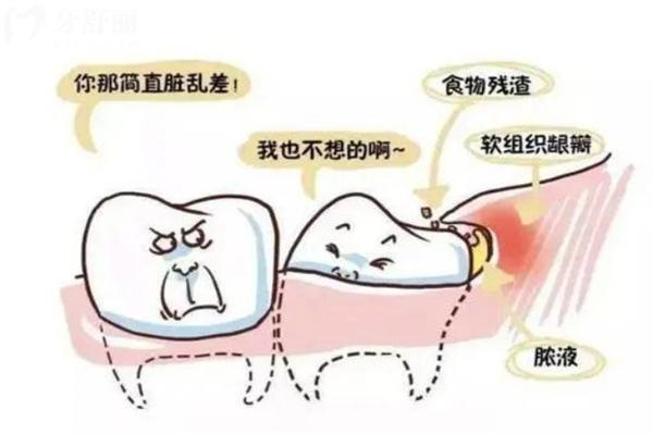 长多颗智齿能一起拔吗?良心医生告知你拔智齿术前术后有哪些注意事项?