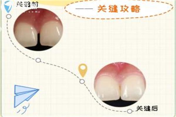 正畸牙缝关闭