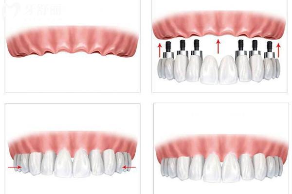 马龙桥种植牙是全固定的吗