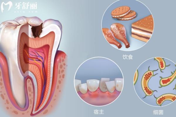 蛀牙不疼但是黑了需要治疗吗