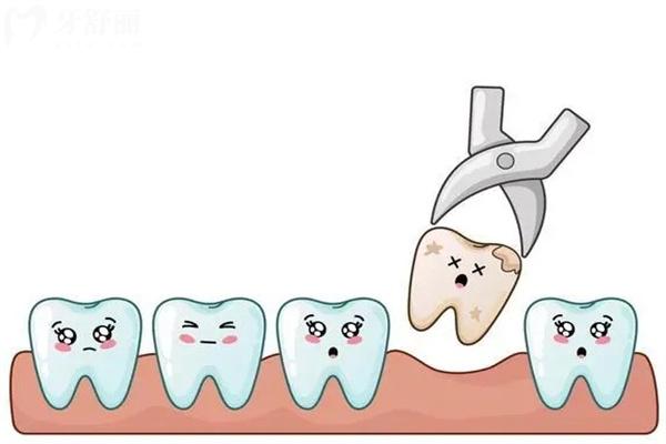 上海拔牙需要多少钱?上海拔牙价格低至80元起附收费标准及实力医院