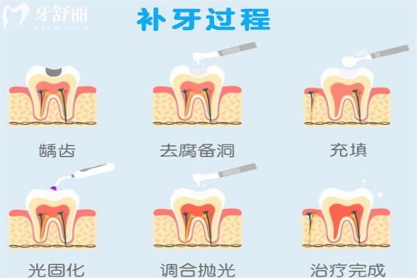 补牙过程