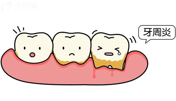 牙周炎的治疗费用是多少钱