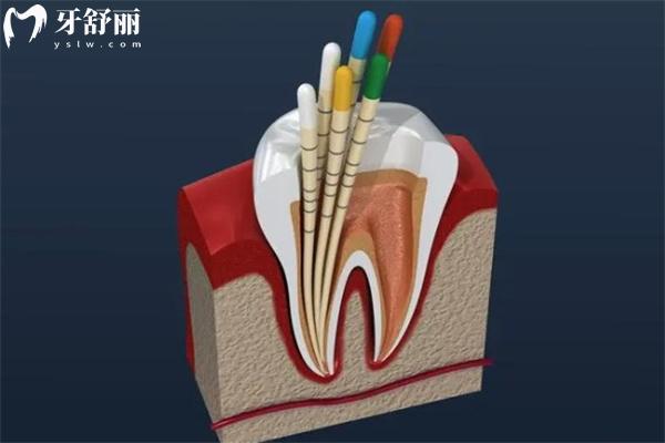 常见牙科项目治疗后维持时间多长揭秘