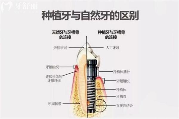 常见牙科项目治疗后维持时间多长揭秘