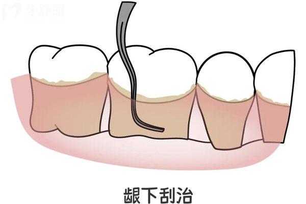 龈下刮治要做几次?轻度/重度/重度不同程度的牙周情况治疗次数不同