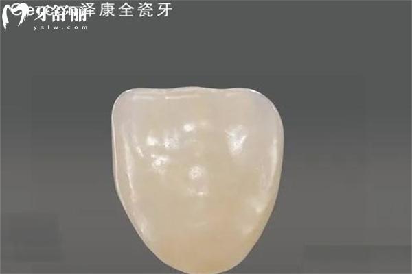 全瓷牙用多久需要更换?盘点常见品牌牙冠使用寿命多久及更换时间