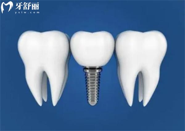 杭州牙科医院种植牙价格表