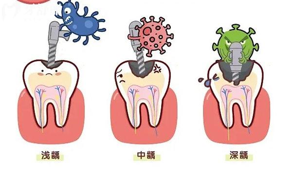 为什么会牙髓坏死？