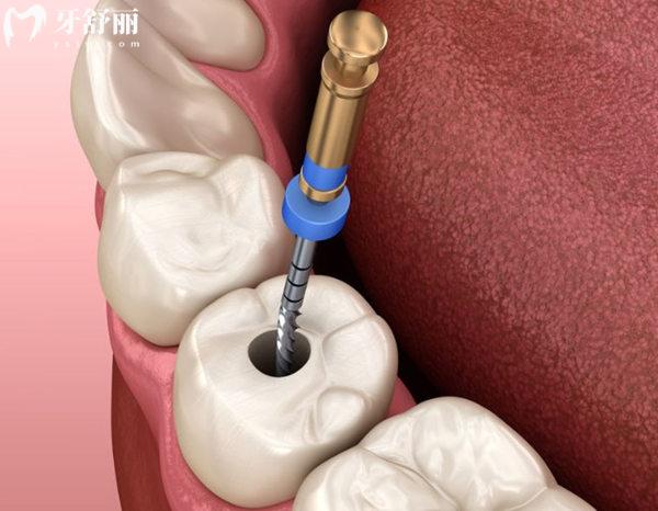 牙髓坏死的治疗方案
