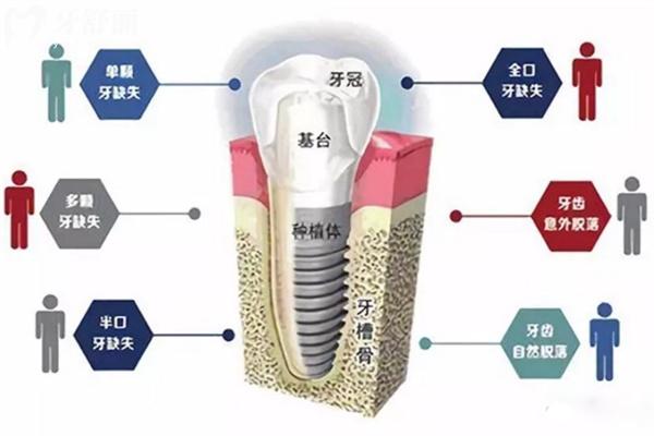 全口即刻种植牙后多久可以吃苹果、蔬菜？