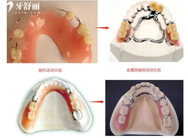 安装活动假牙单颗/半口/全口价格表