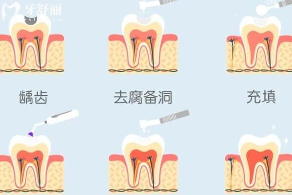 为什么补牙要趁早补？本文带你详细了解补牙那些事