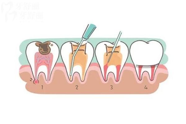 根管治疗能维持多长时间？大概在十年左右 附上延长根管寿命的建议