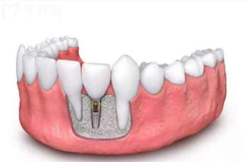 种植牙6.jpg