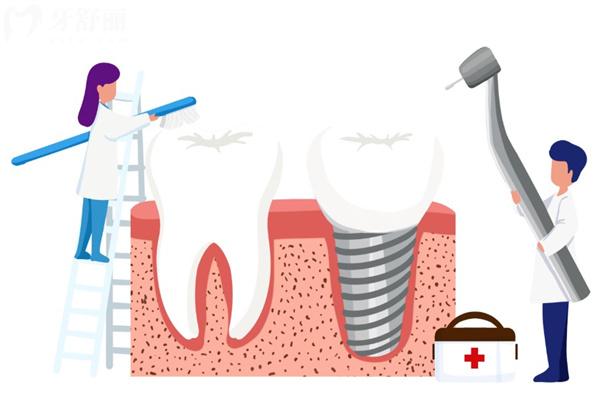 2025全新种植牙保养攻略:更快了解种植牙要怎么清洗和保养才能更耐用