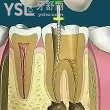 牙齿做完根管治疗后如何护理？可以用漱口水吗？