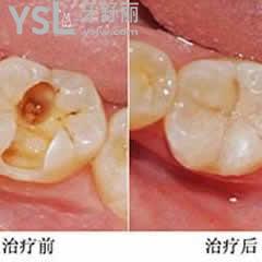 日本GC纳米树脂补牙