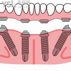 北京佳美口腔瑞士Nobel Active ALL-ON-4种植手术多少钱？