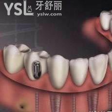 北京中诺口腔医院全口种植牙费用