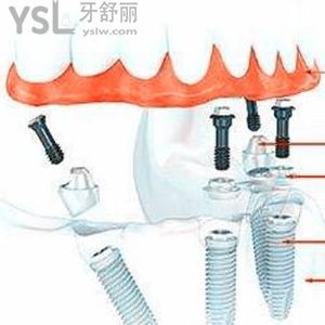 西安中诺口腔医院半口种植牙价格