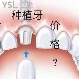 天津美奥口腔贵吗？可以参考下进口种植牙收费如何。