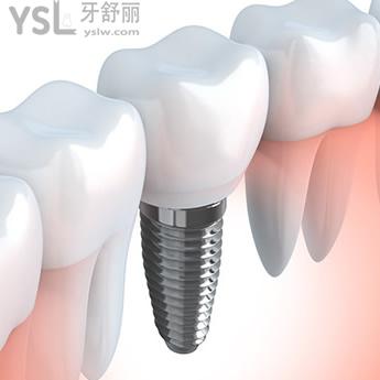 你知道的重庆排名前几的重庆牙博士口腔韩国种植体价格来啦！