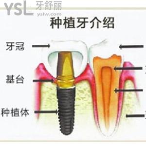 种植牙
