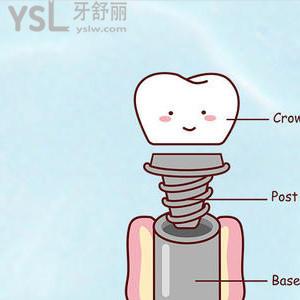 （韩国种植体有哪些品牌）韩国种牙植体哪个品牌好？