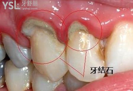 洗牙一次多少钱？时间长吗？