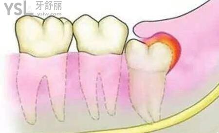 智齿长歪了一定要拔吗？