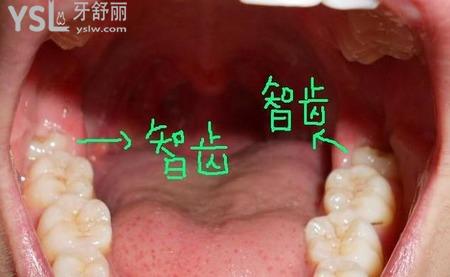 智齿不歪需要拔掉吗？