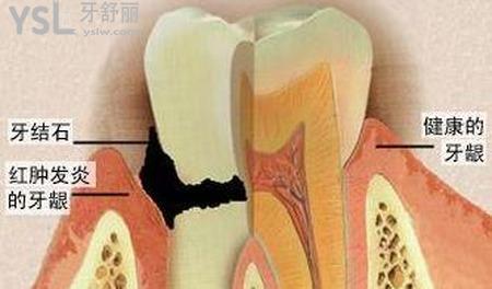 牙周炎有什么症状？