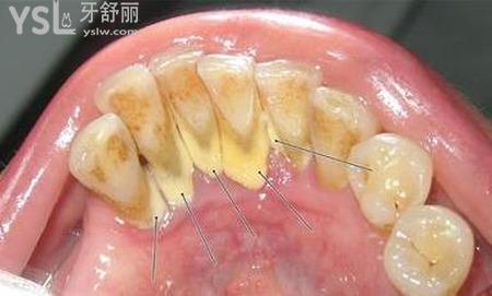 牙齿上有黄垢怎么办？