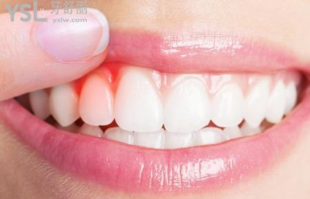 牙齿酸痛怎么缓解？