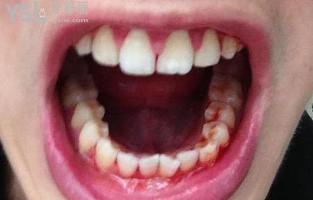 牙龈出血怎么止血最快？